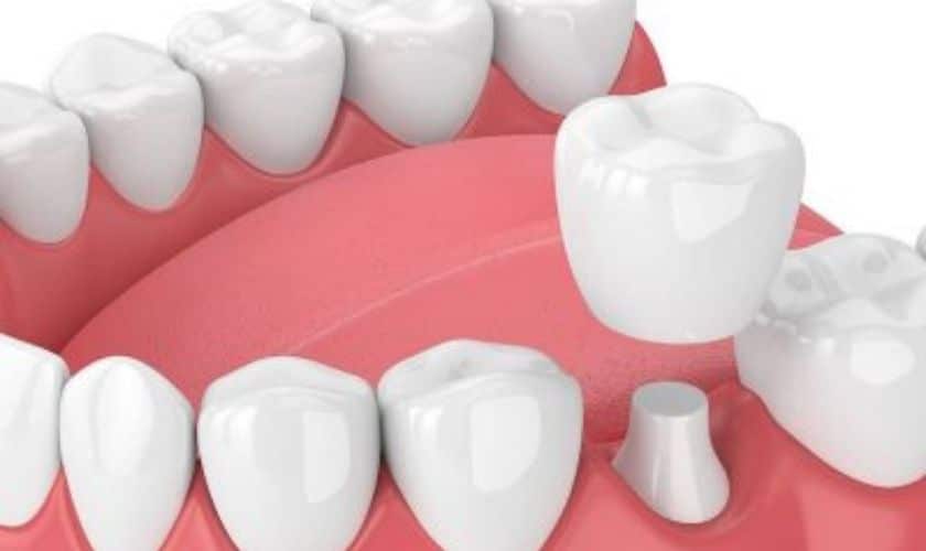 Dental Bridges