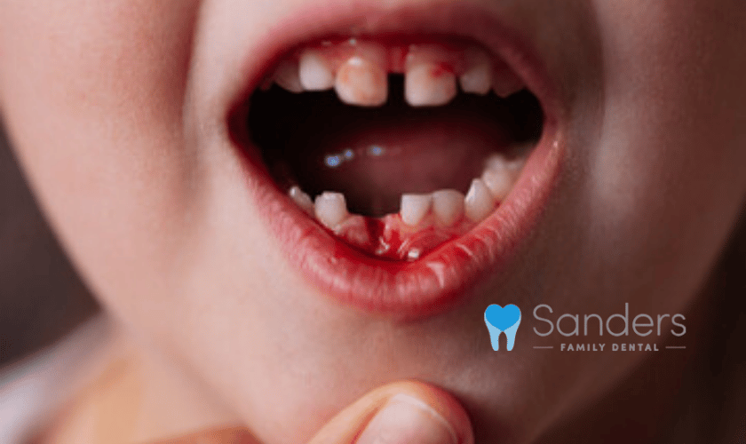 HELP YOUR KID GET RID OF BLEEDING GUMS!