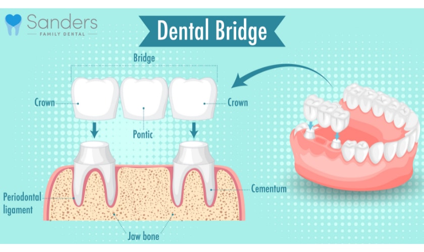 Dental Bridges in Lombard IL