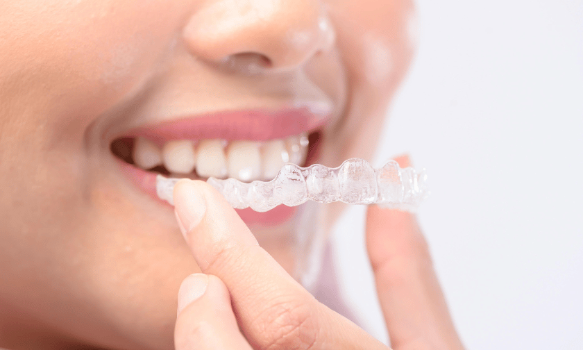 Invisalign