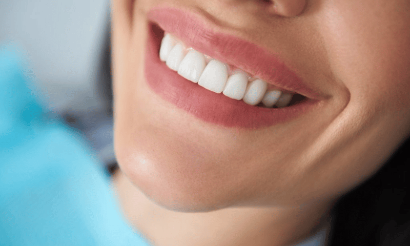 Teeth Whitening