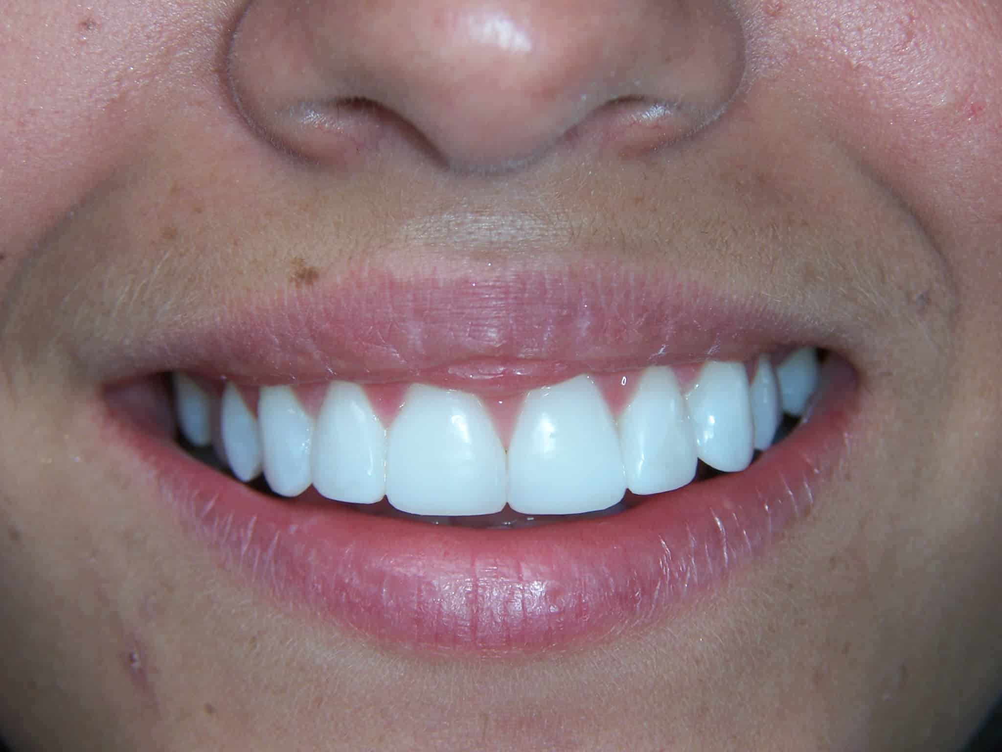 COSMETIC DENTAL BONDING