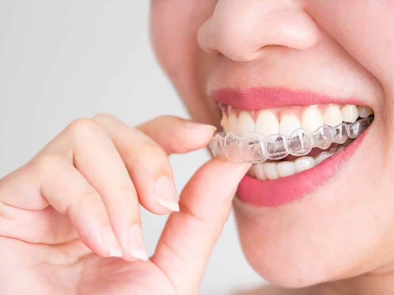 invisalign