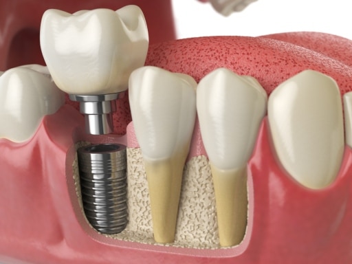 Dental Implant Lombard