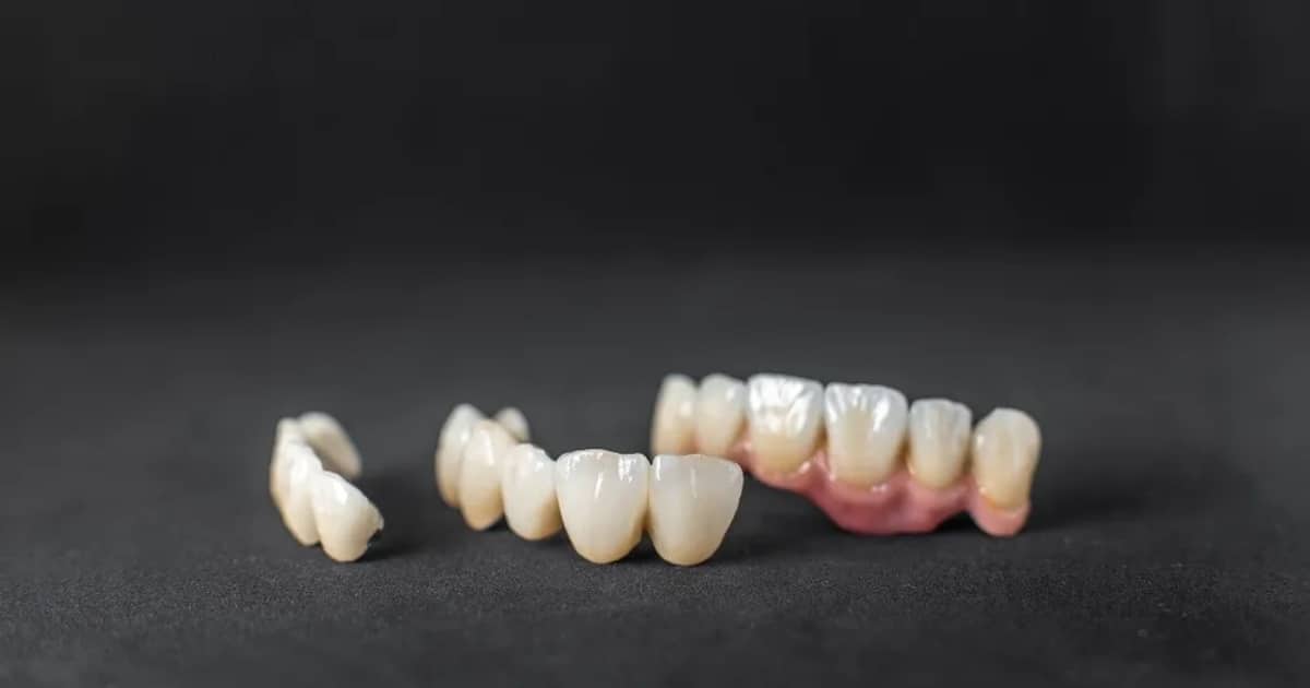Dental Crowns modern techniques shaping a brighter smile