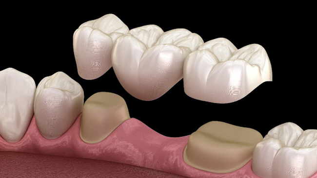 dental bridges in lombard