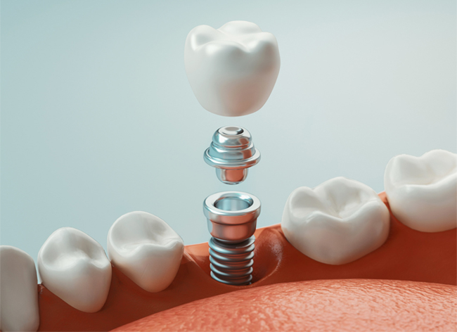 dental implants in lombard