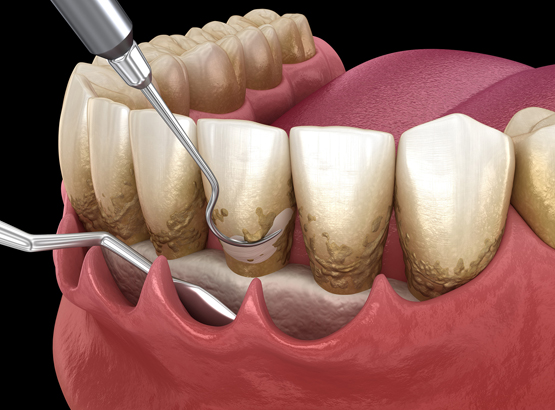 periodontics in lombard