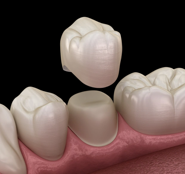 dental-crowns
