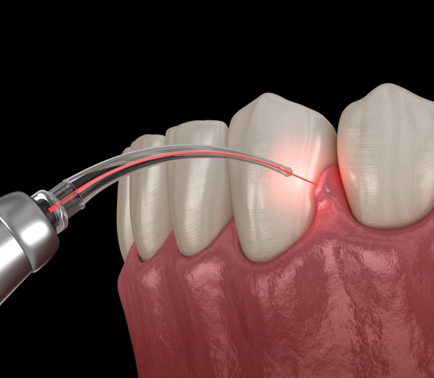 Periodontal Disease Treatment